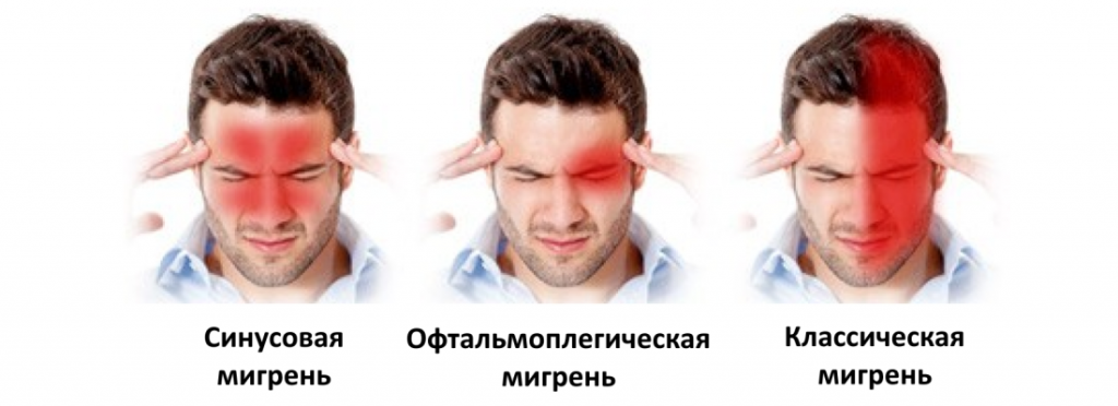 Симптомы, виды и лечение мигрени